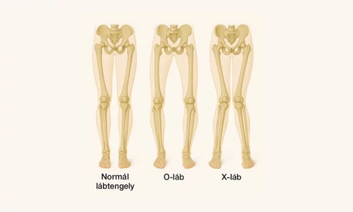 Mitől alakul ki ó láb vagy x láb? Kezelési lehetőségek, amiket szülőként érdemes ismerned