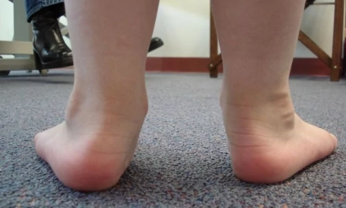 Mikor kell a supinált gyerekszandál?